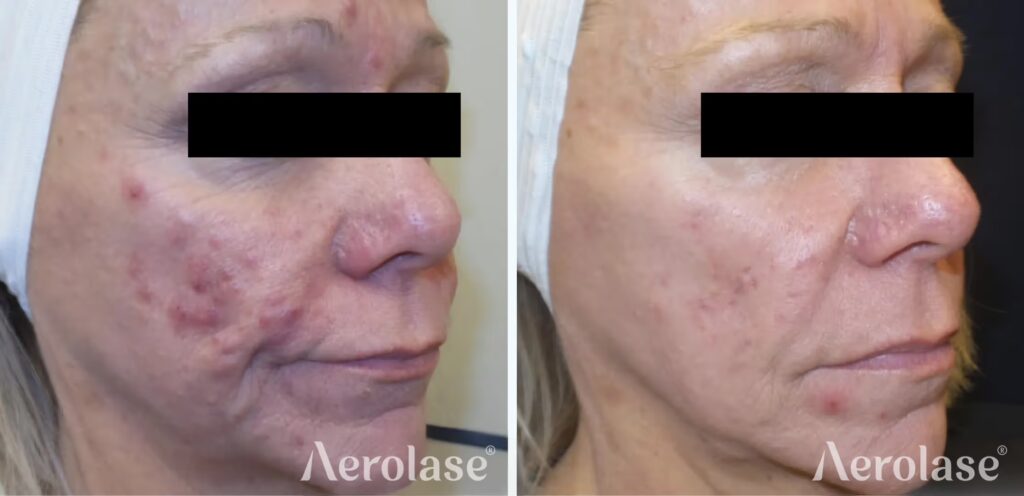 679c9867164f379f7f2dcb2d_111acne-cystic-pinski-before-and-after (1)