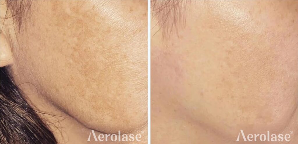 67a0808d145ddf97d3e2197b_new-melasma-Photo-courtesy-of-The-Skin-and-Beauty-Loft